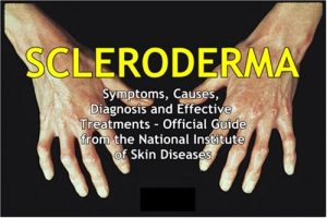 Download SCLERODERMA: Symptoms, Causes, Diagnosis and Effective Treatments – Official Guide from the National Institute of Skin Diseases pdf, epub, ebook